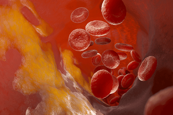 Cholesterol Builds Up