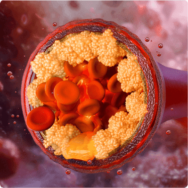 Trapped Cholesterol Gets Released