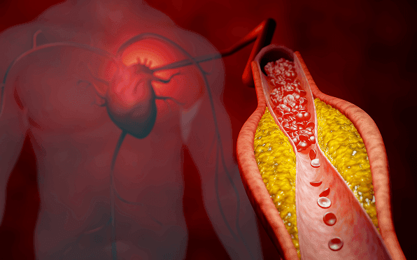 Clot Blocks Artery