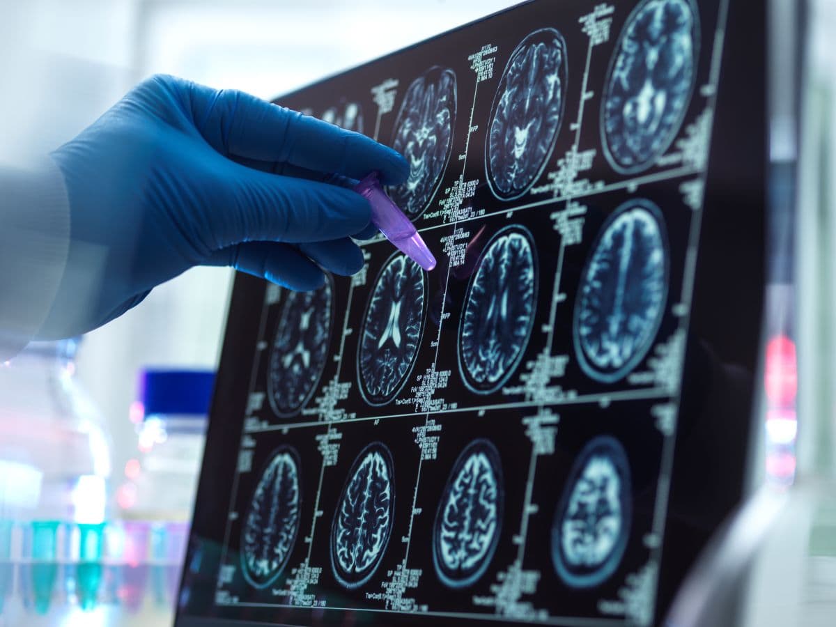 Methylene Blue for Dementia & Alzheimer’s: What Studies Show