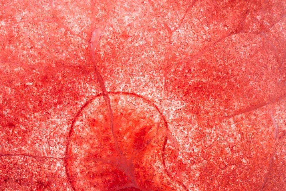 Arterial Inflammation